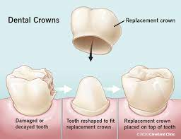 Illustration of how Dental Crowns work, Castle Rock, CO