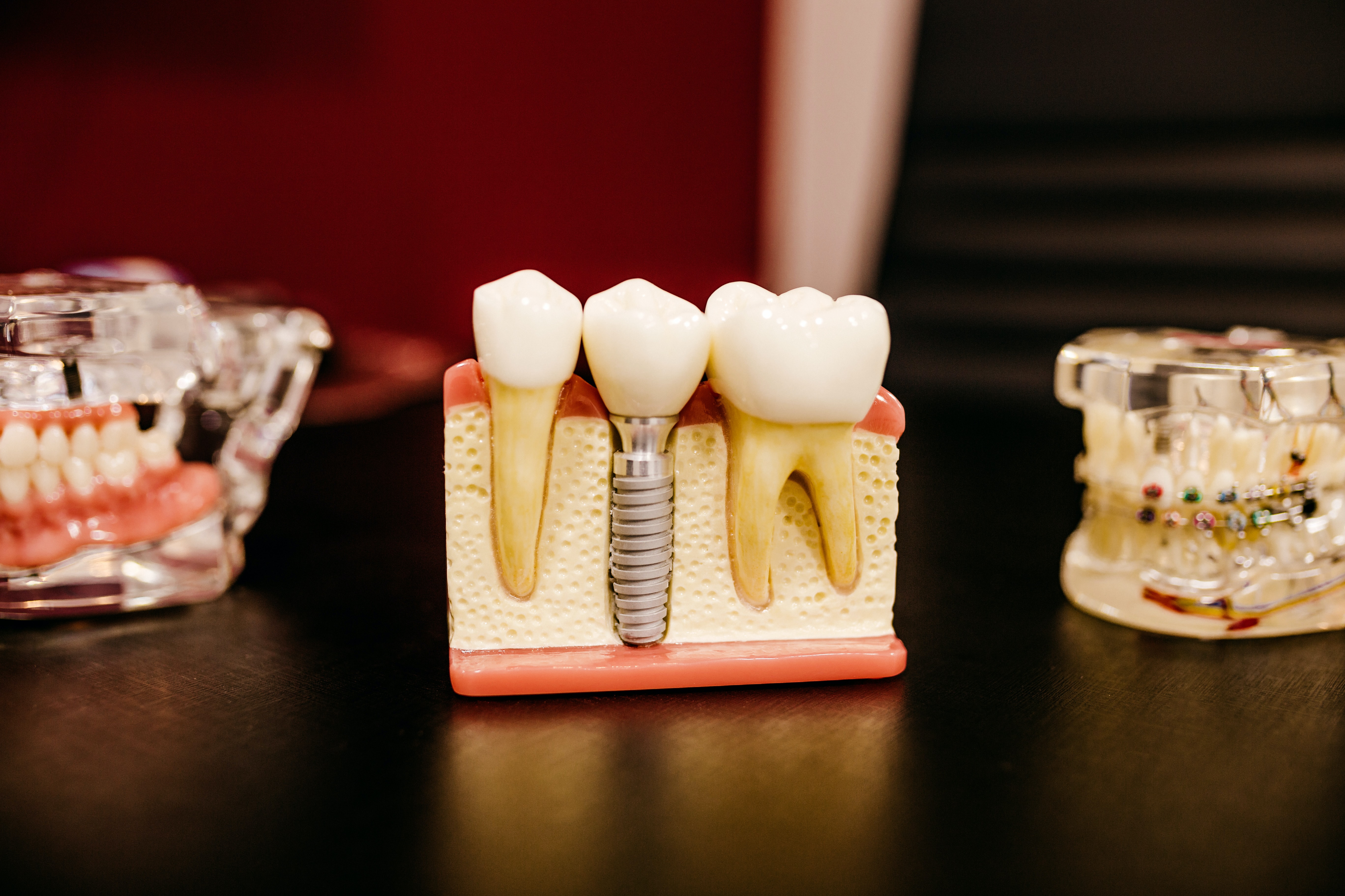 Photograph of Dental Implants model, Castle Rock, CO
